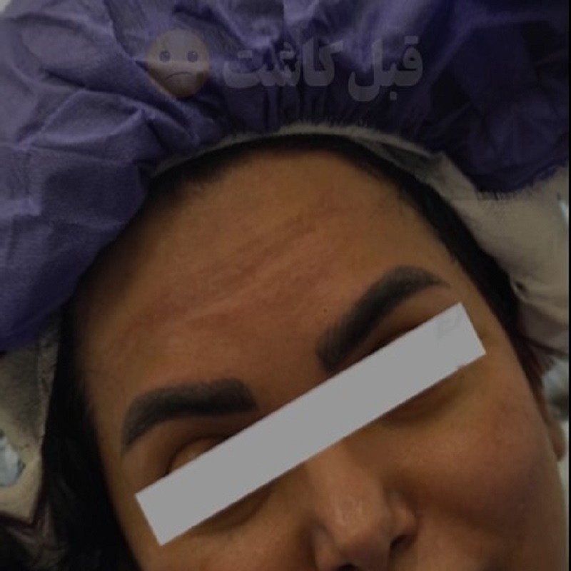 قبل و بعد کاشت ابرو